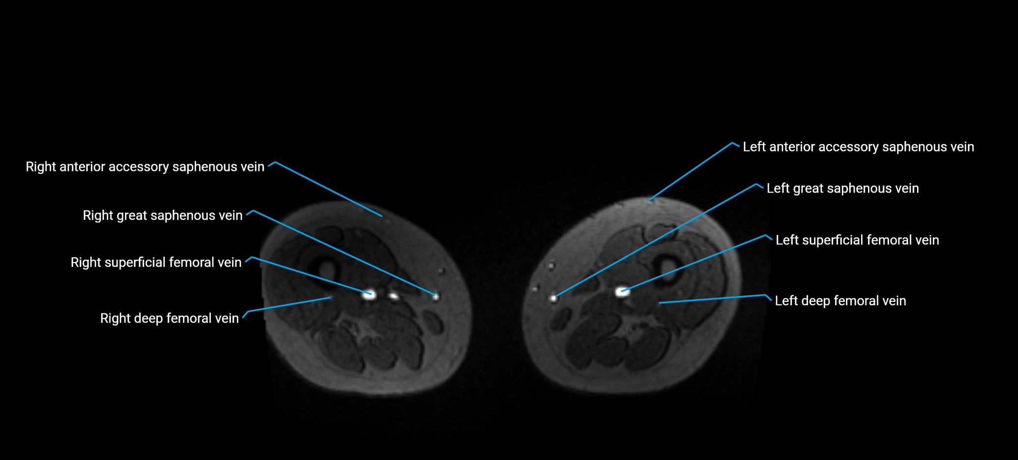 MRV abdomen pelvis & lower limb axial cross sectional anatomy labelled MRI image 296 (1).webp